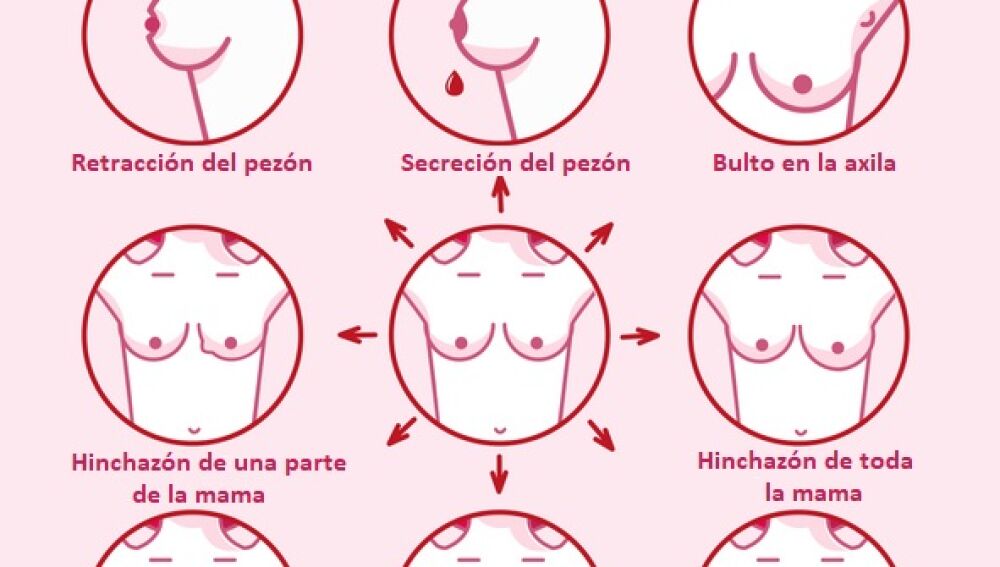 Síntomas del Cáncer de mama