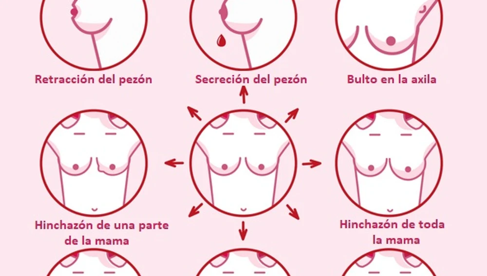 Síntomas del Cáncer de mama Síntomas del Cáncer de mama