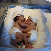 El Hospital Sant Joan de Déu operará a dos siamesas recién nacidas unidas por el abdomen