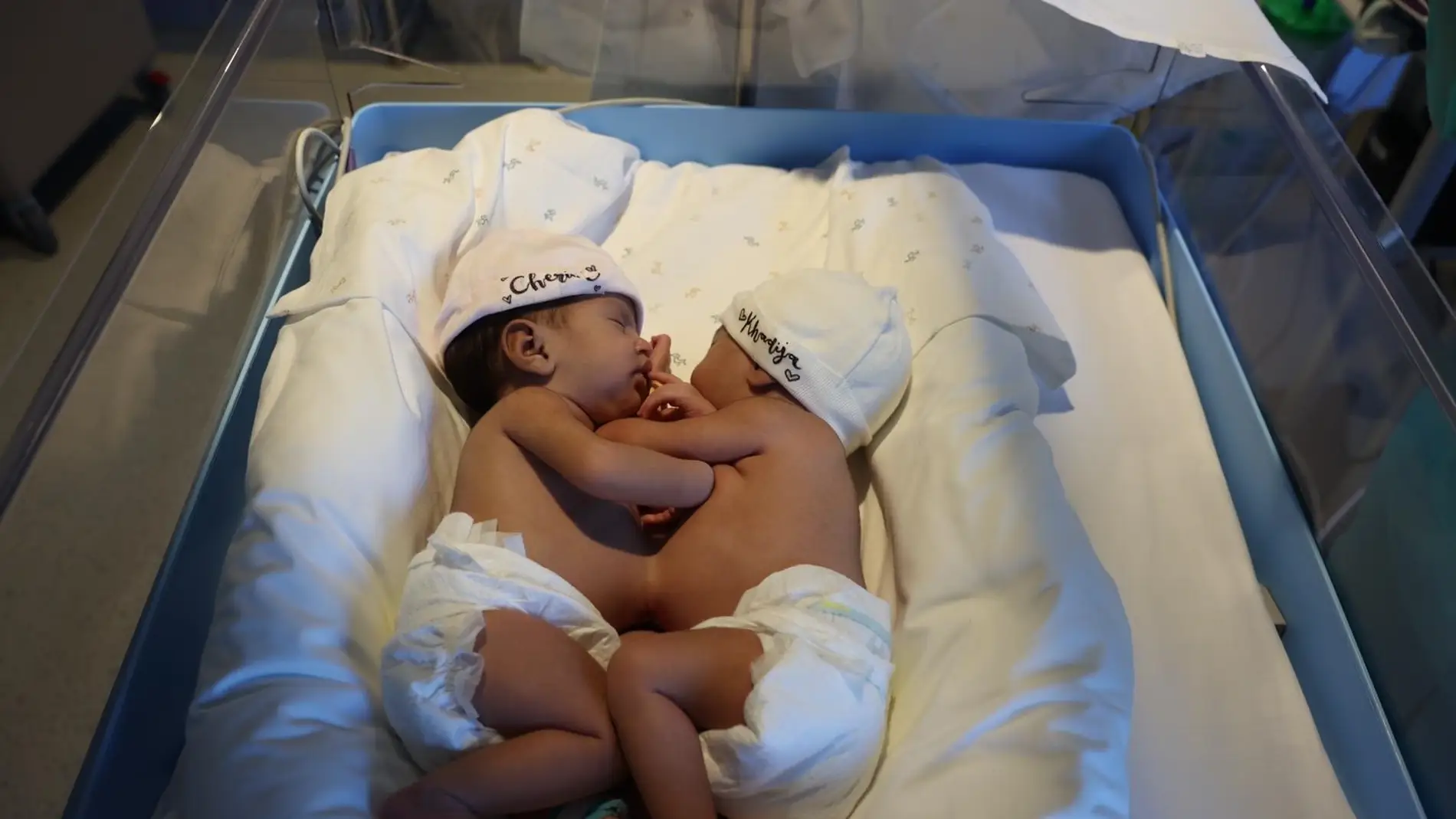 El Hospital Sant Joan de Déu operará a dos siamesas recién nacidas unidas por el abdomen