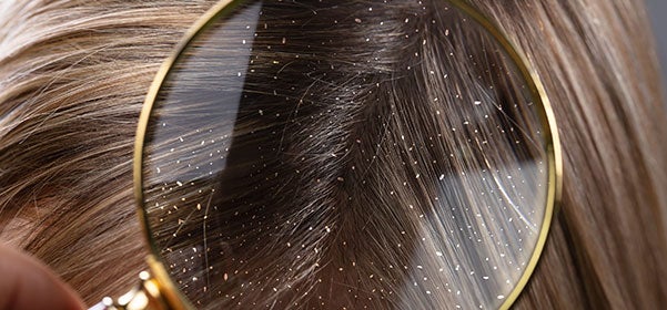 Si quieres actuar contra la caspa, escucha a Encarna Martínez en el espacio Grasman Si quieres actuar contra la caspa, escucha a Encarna Martínez en el espacio Grasman