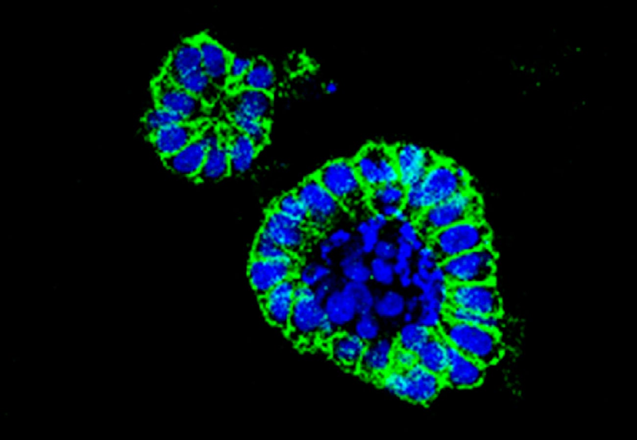 El cribado de cáncer de colon permite detectar más de 600 carcinomas El cribado de cáncer de colon permite detectar más de 600 carcinomas