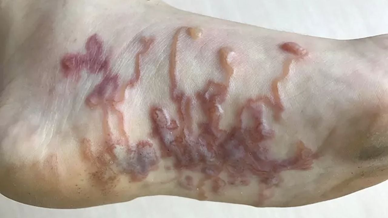 Qué es y cómo se contrae la larva migratoria, el gusano que tiene Lucía Pombo en el pie Qué es y cómo se contrae la larva migratoria, el gusano que tiene Lucía Pombo en el pie