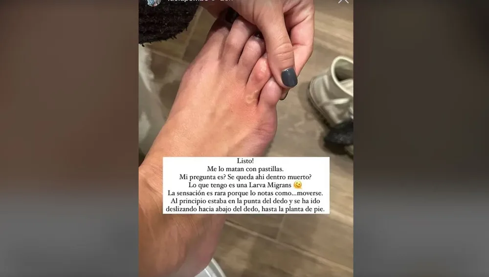 Publicación de Lucía Pombo en la que muestra la larva que tiene en el pie