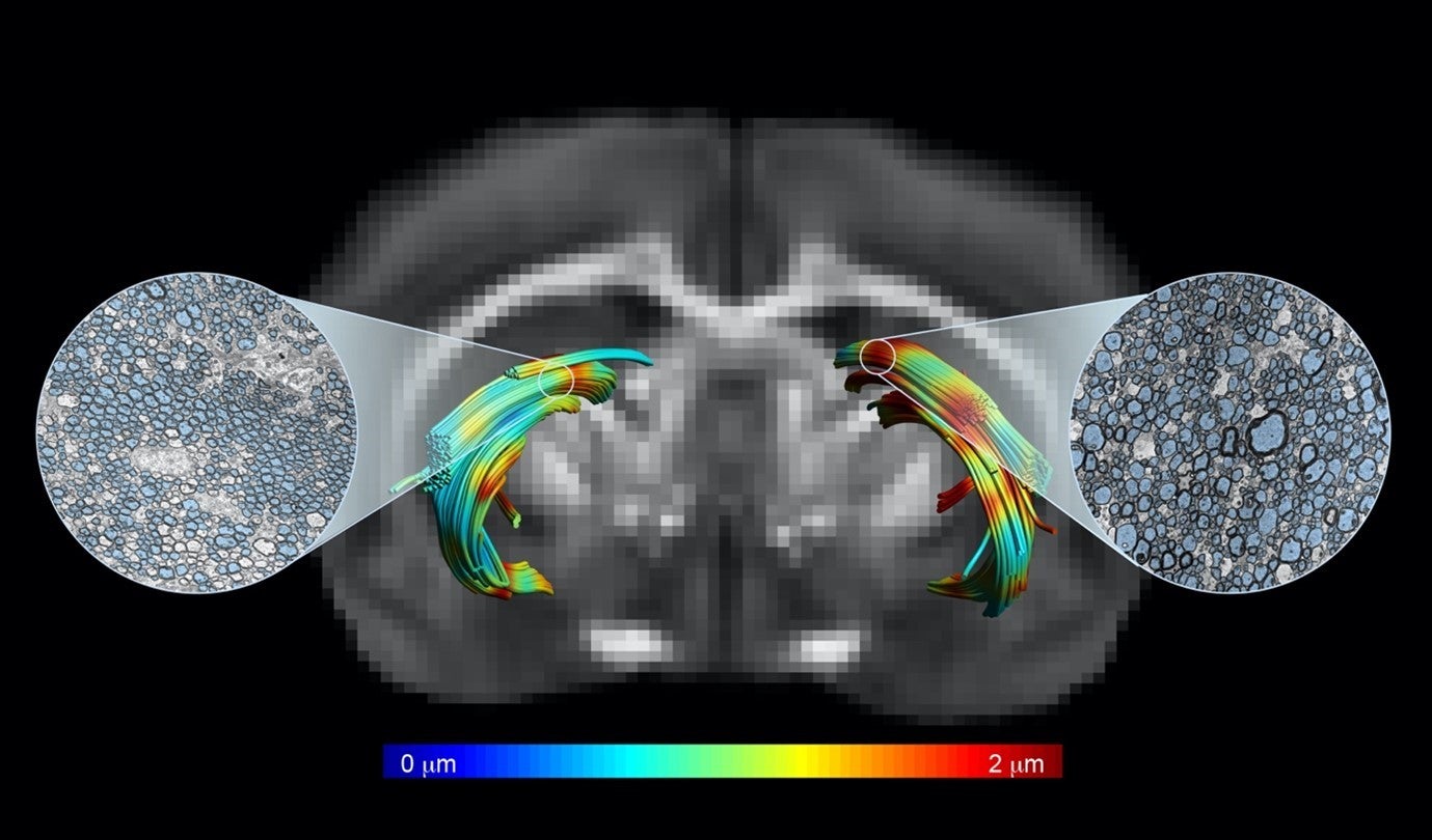 El Instituto de Neurociencias de la UMH de Elche identifica el crecimiento de los axones como señal de la esclerosis múltiple El Instituto de Neurociencias de la UMH de Elche identifica el crecimiento de los axones como señal de la esclerosis múltiple