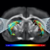  Imagen de resonancia magnética en que se han reconstruido dos tractos de la materia blanca cerebral, uno con daño axonal (dcha.) y otro sano (izda.)