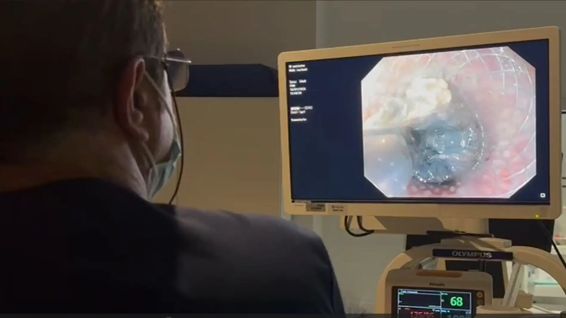 El Hospital Universitario del Vinalopó ha implantado la endoscopia terapéutica avanzada.