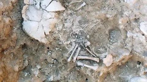 restos niños con síndrome de Down restos niños con síndrome de Down