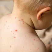Niño con sarampión Niño con sarampión