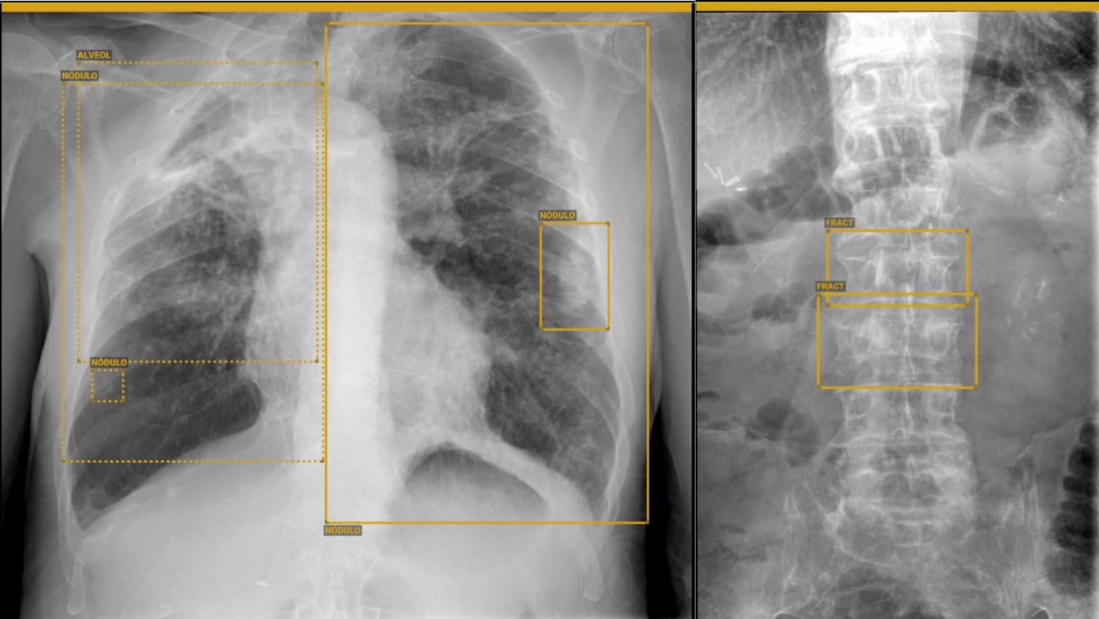 Canarias usa la inteligencia artificial para mejorar la detección de lesiones Canarias usa la inteligencia artificial para mejorar la detección de lesiones