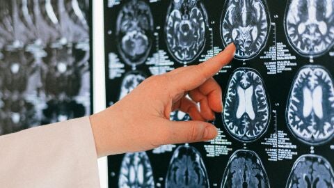 Imagen de archivo de una radiograf&iacute;a cerebral