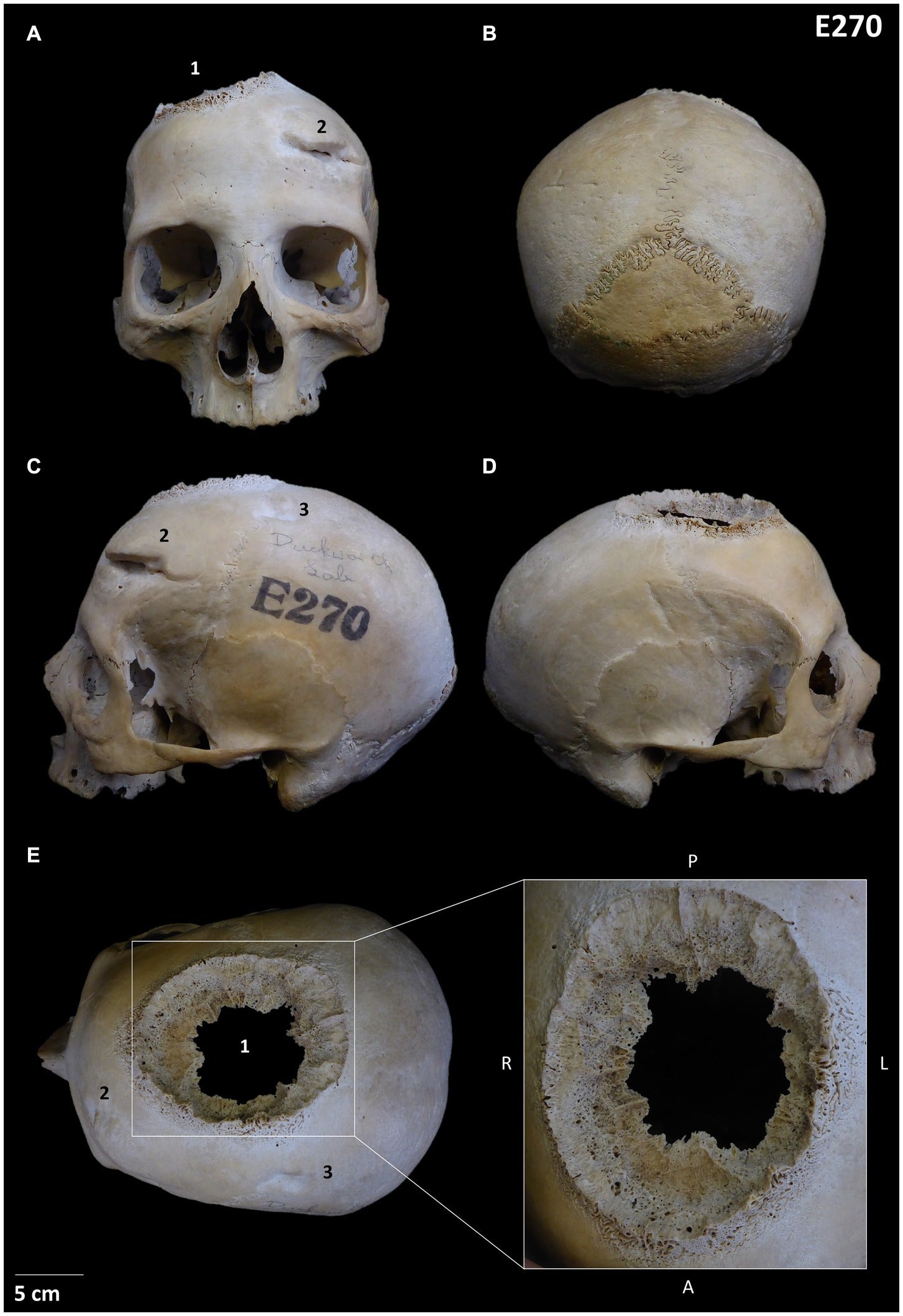 Un cráneo de 4.000 años de antigüedad muestra cómo trataban el cáncer los egipcios Un cráneo de 4.000 años de antigüedad muestra cómo trataban el cáncer los egipcios