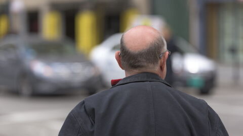 La calvicie masculina tambi&eacute;n encuentra soluci&oacute;n en Centros Grasman, con pr&oacute;tesis totalmente personalizadas