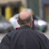 Prótesis personalizadas: la solución definitiva cuando la caída del cabello en hombres es irreversible 