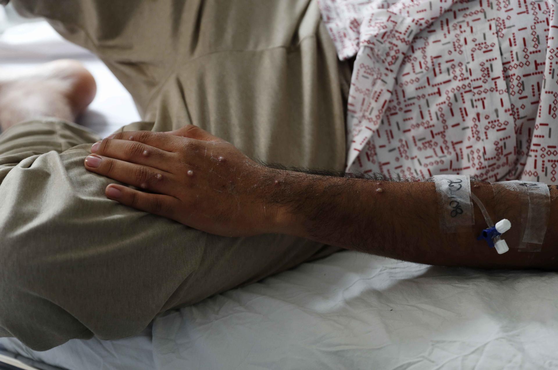 La OMS decidirá este miércoles si declara la viruela del mono emergencia sanitaria internacional La OMS decidirá este miércoles si declara la viruela del mono emergencia sanitaria internacional