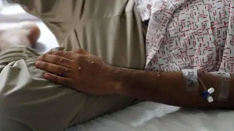 Imagen de archivo de un paciente tras ser diagnosticado con la viruela del mono. Imagen de archivo de un paciente tras ser diagnosticado con la viruela del mono.
