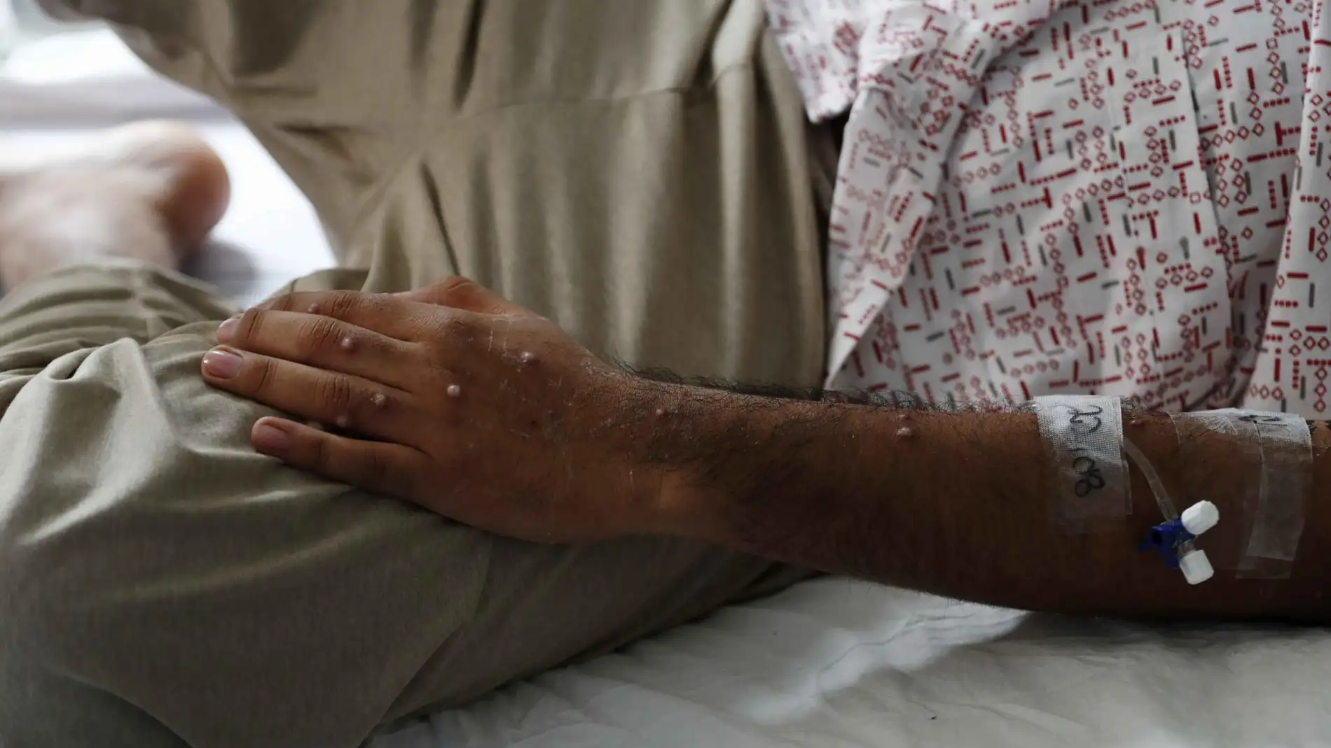 Imagen de archivo de un paciente tras ser diagnosticado con la viruela del mono. Imagen de archivo de un paciente tras ser diagnosticado con la viruela del mono.