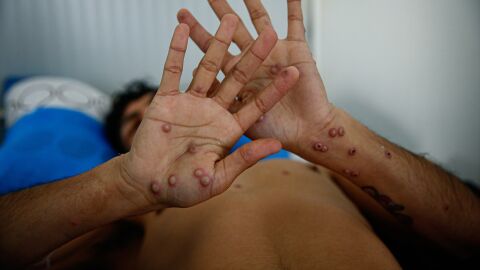 Imagen de archivo de una persona infectada con viruela del mono en el hospital 