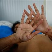 Imagen de archivo de una persona infectada con viruela del mono en el hospital 