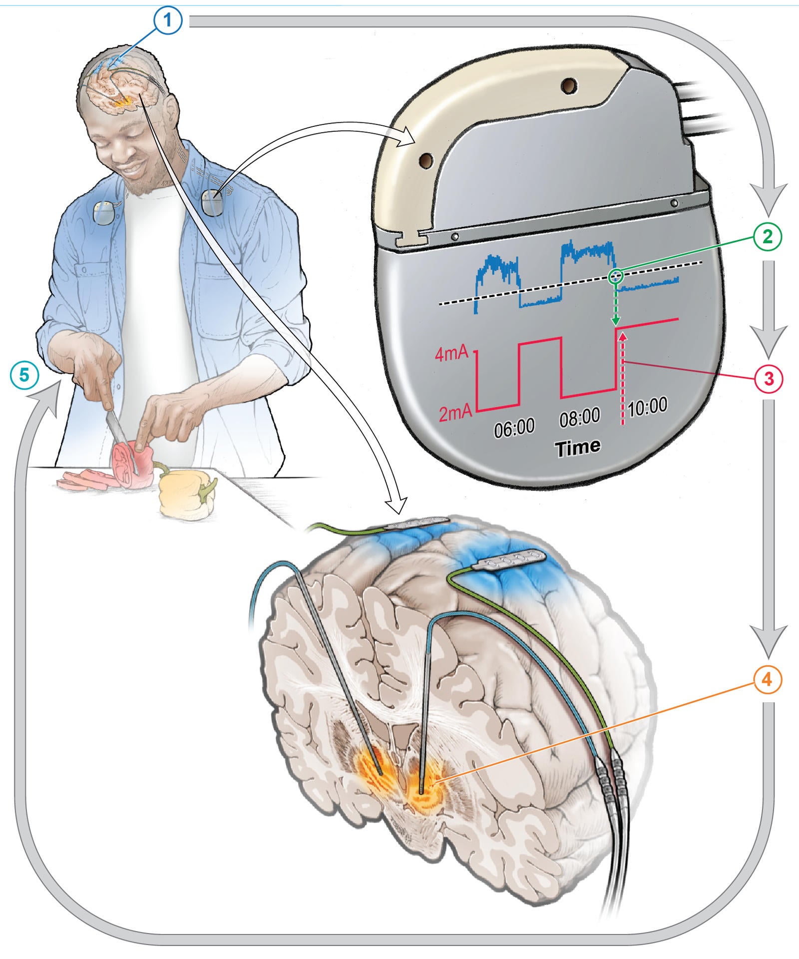 Un marcapasos cerebral inteligente reduce los síntomas en los pacientes con párkinson Un marcapasos cerebral inteligente reduce los síntomas en los pacientes con párkinson