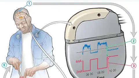 Un marcapasos cerebral puede reducir los síntomas del parkinson Un marcapasos cerebral puede reducir los síntomas del parkinson