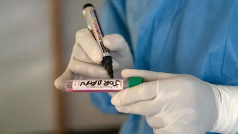 Un experto señala que la viruela del mono "ni de lejos es una situación similar al Covid" Un experto señala que la viruela del mono "ni de lejos es una situación similar al Covid"