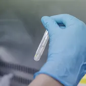 Una técnico de laboratorio sostiene una de las pruebas de análisis para la viruela del mono, en el Hospital Ramón y Cajal, a 30 de mayo de 2022, en Madrid (España) - Carlos Luján Una técnico de laboratorio sostiene una de las pruebas de análisis para la viruela del mono, en el Hospital Ramón y Cajal, a 30 de mayo de 2022, en Madrid (España) - Carlos Luján