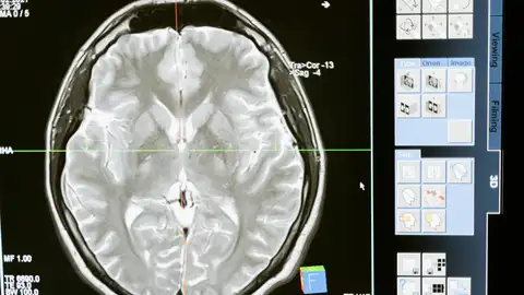 Un fármaco contra el cáncer podría tratar el Alzheimer en etapa temprana, según un estudio Un fármaco contra el cáncer podría tratar el Alzheimer en etapa temprana, según un estudio
