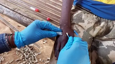 Médico coge una muestra de un paciente de mpx en la República Democrática del Congo Médico coge una muestra de un paciente de mpx en la República Democrática del Congo