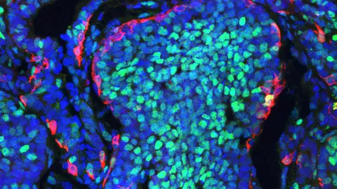 Imagen de un tumor de mama en ratón que muestra la segregación de las poblaciones celulares identificadas en el estudio. Imagen de un tumor de mama en ratón que muestra la segregación de las poblaciones celulares identificadas en el estudio.