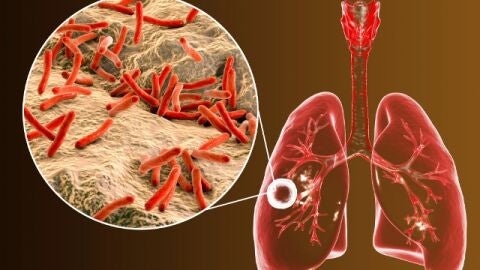 El SES activa la vigilancia epidemiol&oacute;gica ante un caso de tuberculosis relacionado con un colegio de Badajoz