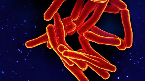 El SES confirma el cuarto caso de tuberculosis relacionado con el CEIP Juventud de Badajoz El SES confirma el cuarto caso de tuberculosis relacionado con el CEIP Juventud de Badajoz