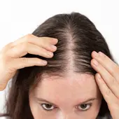 Grasman pone solución al problema de calvicie en la mujer con la técnica del volumater Grasman pone solución al problema de calvicie en la mujer con la técnica del volumater