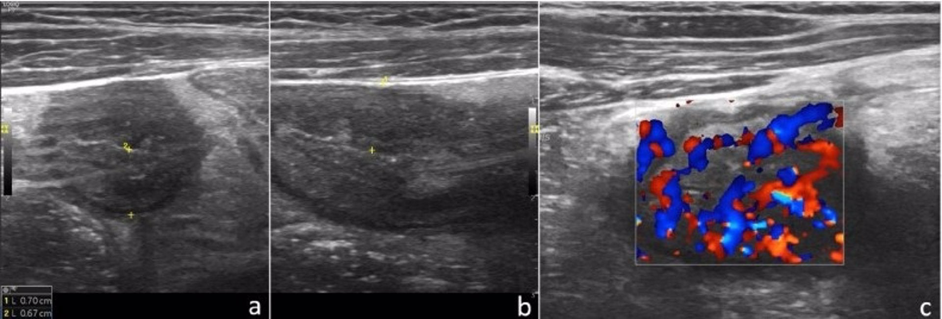 Un estudio de la UEx evidencia la eficacia de la ecografía pediátrica en la detección precoz de la enfermedad de Crohn Un estudio de la UEx evidencia la eficacia de la ecografía pediátrica en la detección precoz de la enfermedad de Crohn