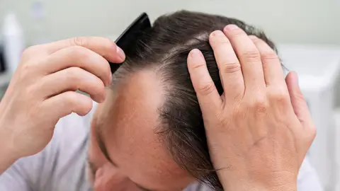 Imagen de archivo: hombre adulto con problemas de calvicie Imagen de archivo: hombre adulto con problemas de calvicie