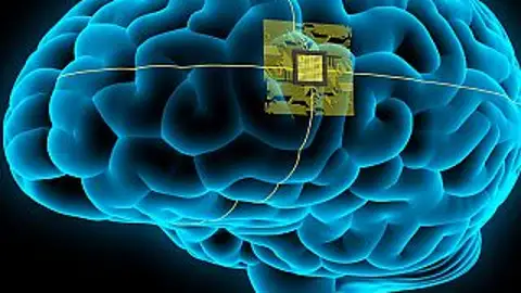 Implante cerebral Implante cerebral
