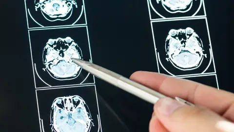 Imagen de recurso. Resultados de una prueba cerebral Imagen de recurso. Resultados de una prueba cerebral