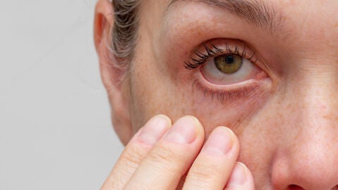 S&iacute;ndrome del ojo seco