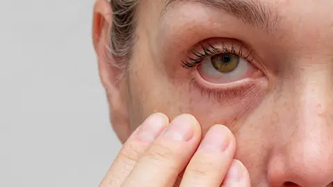 Síndrome del ojo seco Síndrome del ojo seco