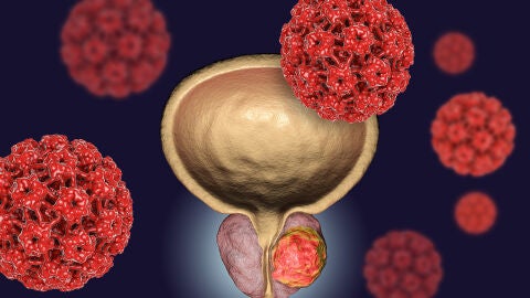cáncer de próstata cáncer de próstata