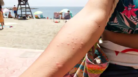 Un ejemplo de picaduras de medusa Un ejemplo de picaduras de medusa