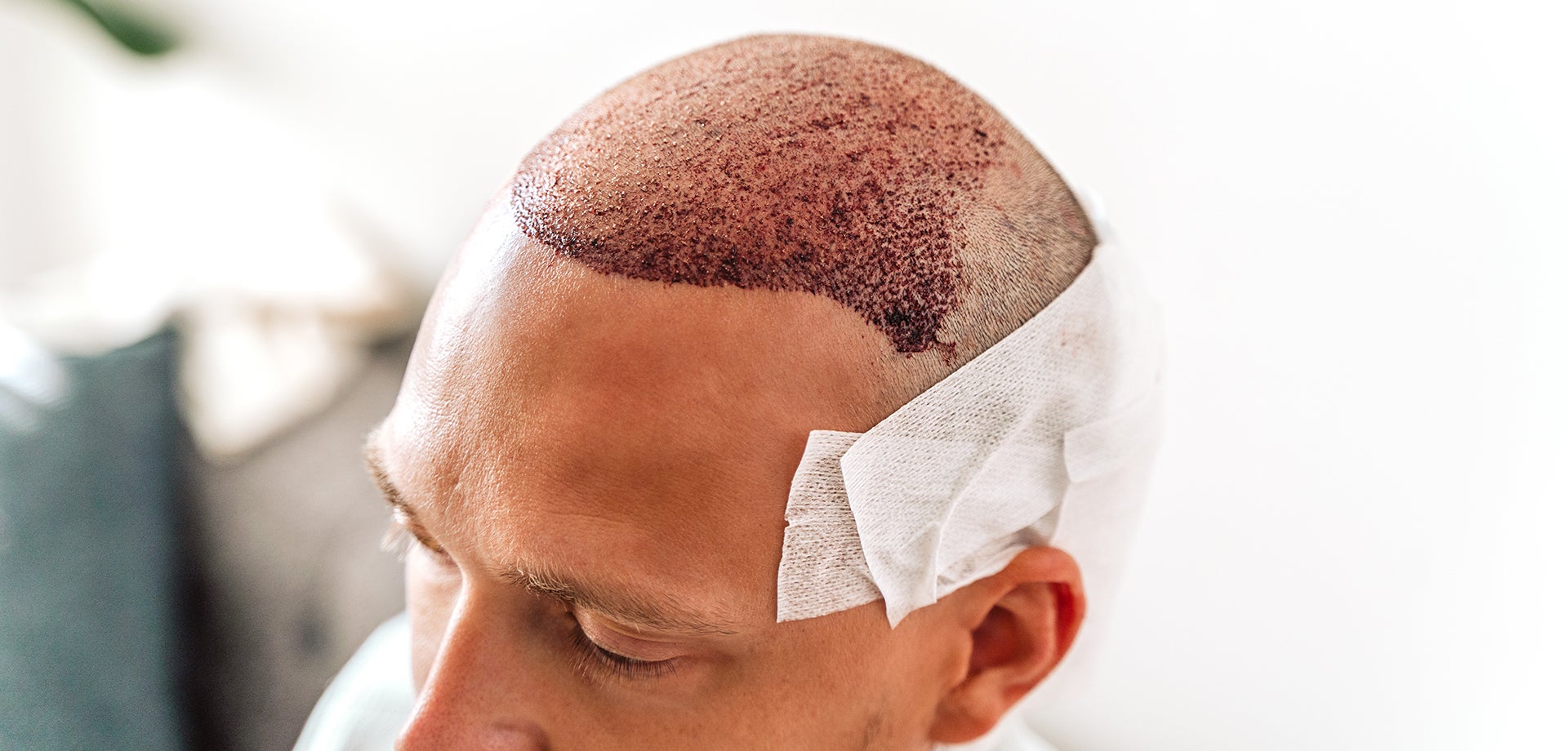 Muere un hombre de 38 años cuando estaba a punto de hacerse un trasplante capilar en Turquía Muere un hombre de 38 años cuando estaba a punto de hacerse un trasplante capilar en Turquía