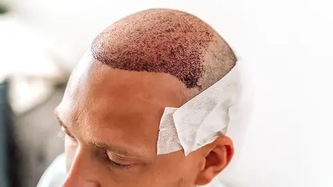 Muere un hombre de 38 años que iba a hacerse un trasplante de pelo en Turquía Muere un hombre de 38 años que iba a hacerse un trasplante de pelo en Turquía