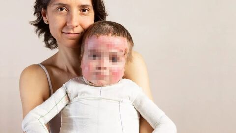 Ni&ntilde;o afectado por piel de mariposa