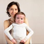 Niño afectado por piel de mariposa
