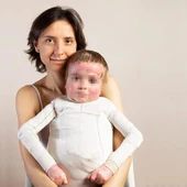 Niño afectado por piel de mariposa Niño afectado por piel de mariposa