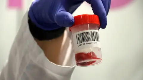 El banc de cordó umbilical vol revertir la caiguda de donacions amb una nova tècnica El banc de cordó umbilical vol revertir la caiguda de donacions amb una nova tècnica