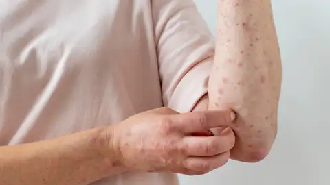 Una persona con sarampión Una persona con sarampión