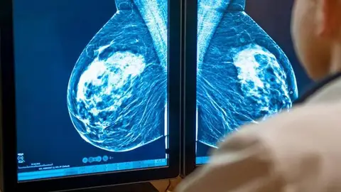 Johana, de 26 años, fue diagnosticada de cáncer de mama Johana, de 26 años, fue diagnosticada de cáncer de mama