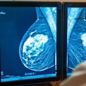 Johana, de 26 años, fue diagnosticada de cáncer de mama